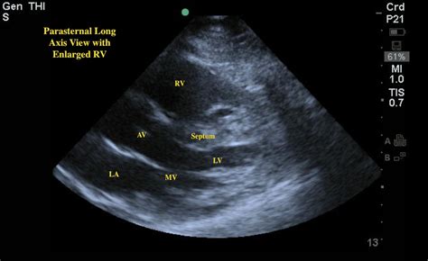 d sign ultrasound pulmonary embolism.